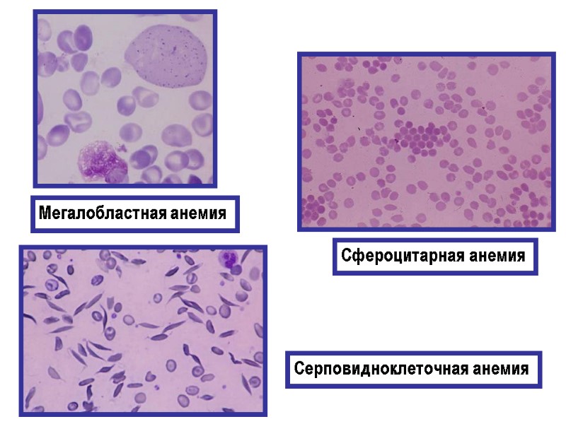 Мегалобластная анемия Серповидноклеточная анемия Сфероцитарная анемия